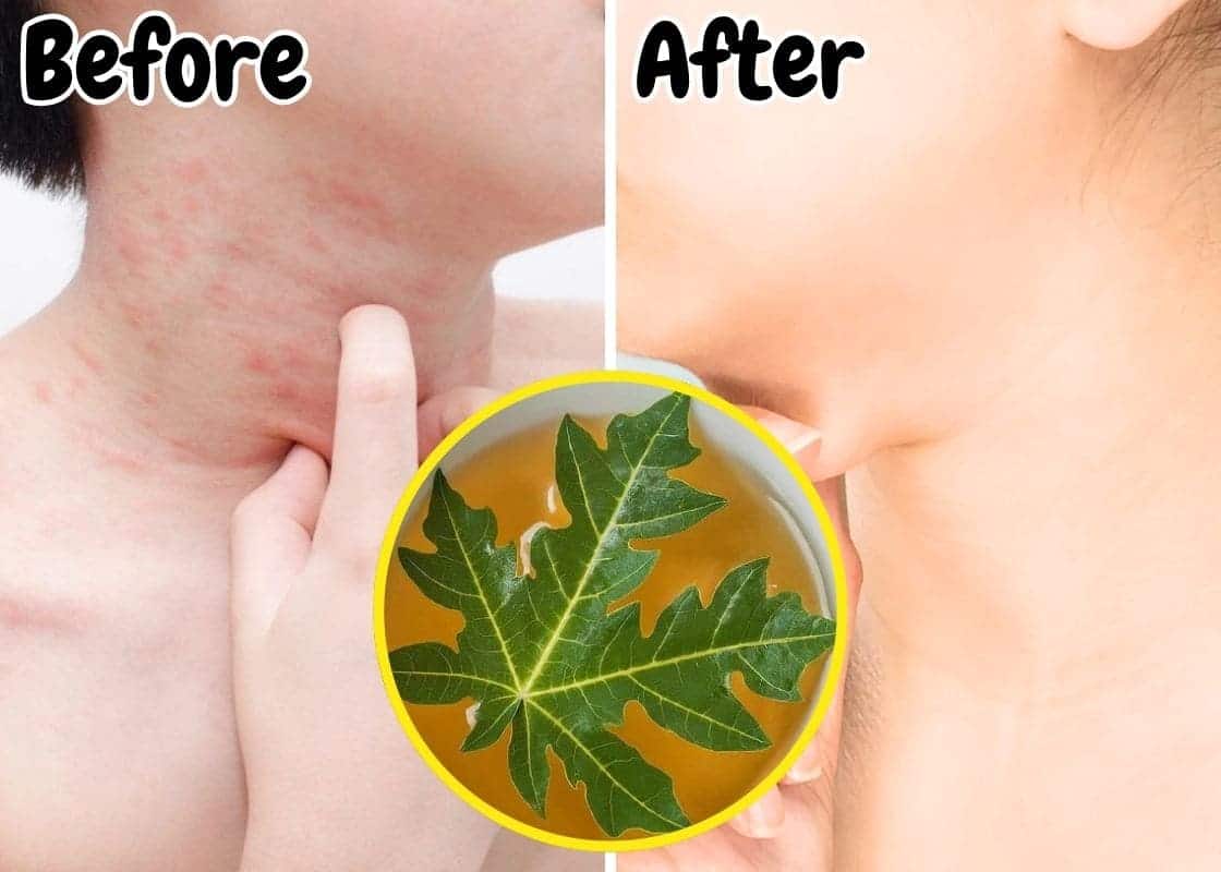 Why Everyone Battling Dengue Fever Should Know Papaya Leaf